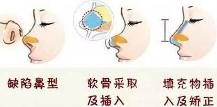 隆鼻术的优缺点有哪些?
