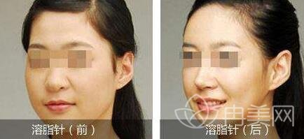 光纤溶脂瘦脸是的吗？会反弹吗？