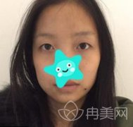 山西省整形外科医院刘晋元隆鼻怎么样?医生案例90天后果图分享