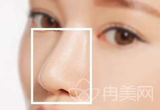 做鼻子有几种方法？术后多久才能恢复？