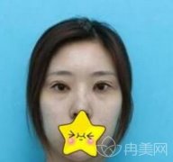 重庆西南医院整形科,及双眼皮案例术后果