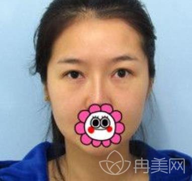 上海陈超群整形医生去眼袋
