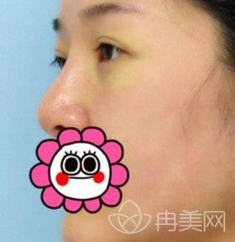 上海陈超群整形医生去眼袋