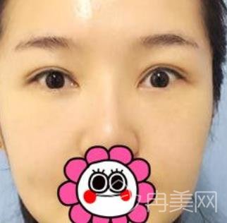 上海陈超群整形医生去眼袋