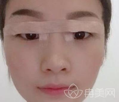 北京刘凤卓双眼皮案例*果展示，附价格表明细一览