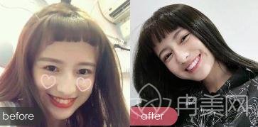 广西江滨医院整形科牙齿美白案例：