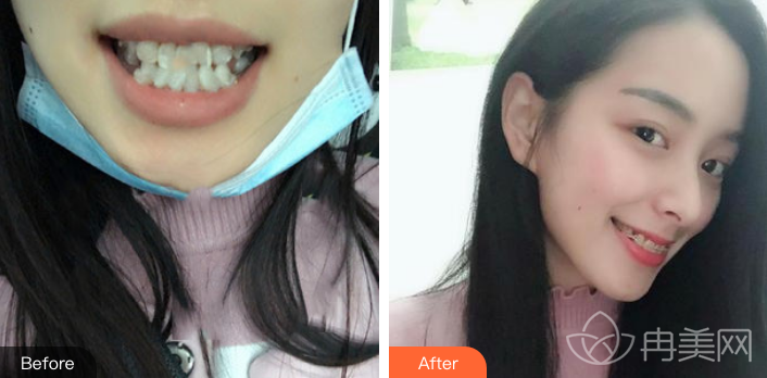 上海科瓦口腔门诊部半隐形牙齿矫正案例