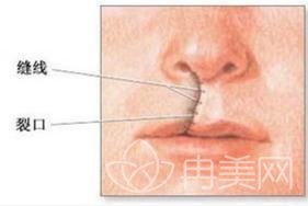 唇裂修复术的手术全过程是怎样的的？手术风险大吗？