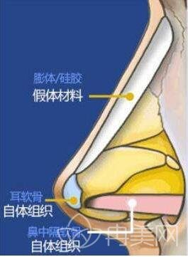 【消疑惑】硅胶隆鼻术后会挛缩吗?会不会变成猪鼻?