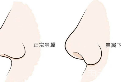 大鼻头如何缩小鼻翼?有哪些方法可以改良?