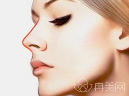 假体隆鼻VS玻尿酸隆鼻，哪种隆鼻材料（方式）更好？