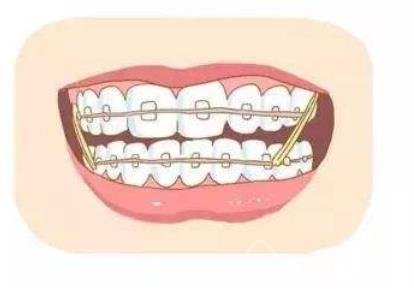 关于牙齿矫正的事情，这八点你都掌握了吗?