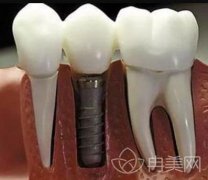 你们知道种植牙有哪些利与弊吗？