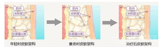 电波拉皮除皱*吗?有没有副作用?