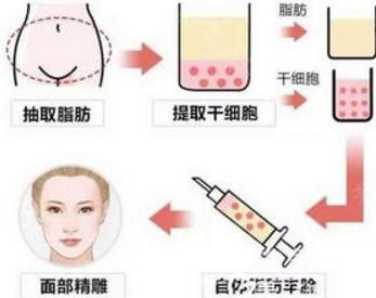 面部填充术后出现脸僵？教你如何避免！