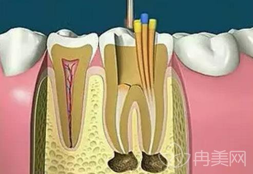 做过根管的牙能用几年？术后还出现牙疼的情况怎么办？