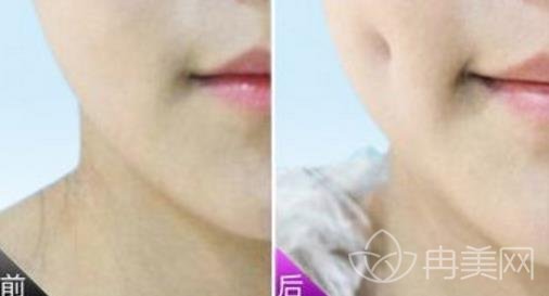 酒窝整形术有几种做法?价格区间是多少？