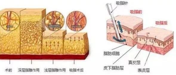 抽脂减肥真的有用吗?通常有哪些整形方法?