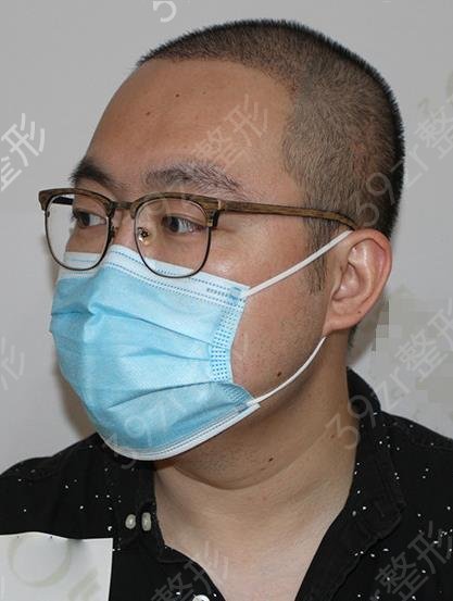 
植发靠谱么搜搜海峡植发hx