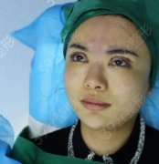 桂林181医院割双眼皮案例前后图！在分享眼整形标准