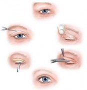 埋线双眼皮有什么特点?埋线双眼皮手术后怎么护理?
