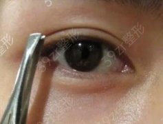做双眼皮手术多少钱?影响双眼皮手术的因素有哪些?