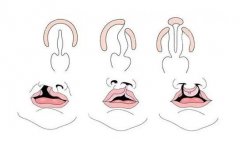 唇裂手术前的注意事项有哪些?
