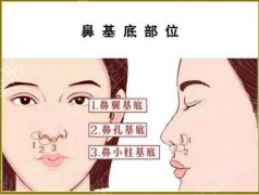 鼻基底填充多久能恢复?消肿要多久?