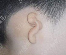 先天性小耳畸形的原因是什么?先天性小耳畸形应该怎么调节?