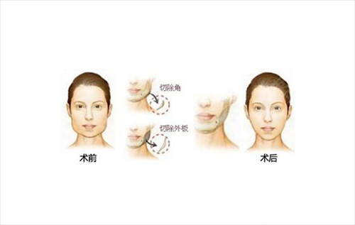 中国人民解放军总医院（原北京301医院）整形科改脸型案例