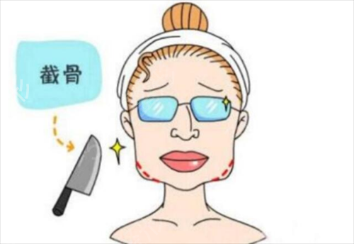 北京清华长庚医院整形美容科去下颌角案例
