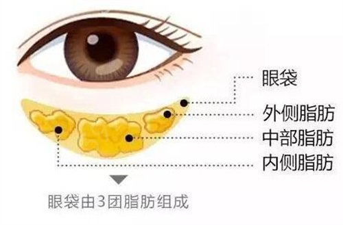 北京朝阳医院整形外科祛眼袋案例