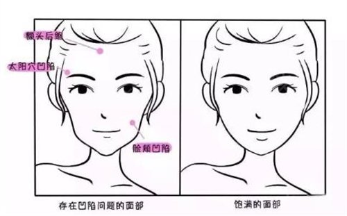 北京天坛医院整形美容科自体脂肪面部填充案例