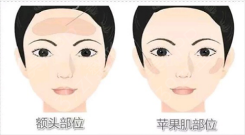 北京大学人民医院整形美容外科面部脂肪填充案例
