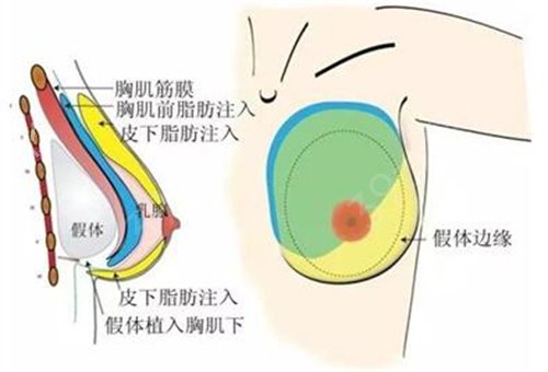 广西民族医院整形外科自体脂肪隆胸案例：