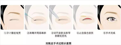 桂林市第二人民医院整形外科全切双眼皮案例：