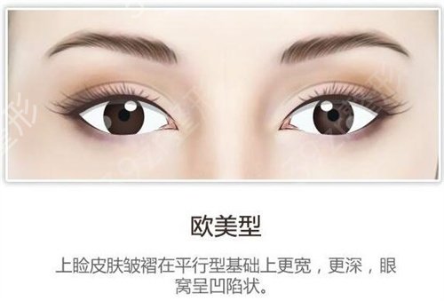 青州市人民医院双眼皮案例