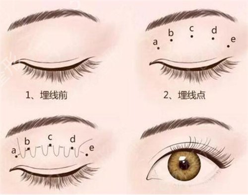 广西壮族自治区民族医院整形科割双眼皮案例：