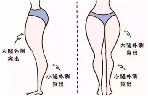 广西医科大学第二附属医院整形科大腿吸脂案例：