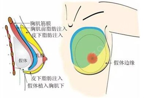 广州联合丽格医疗美容医院自体脂肪隆胸案例：