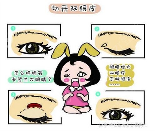 首都医科大学附属北京第一医院整形美容科双眼皮案例