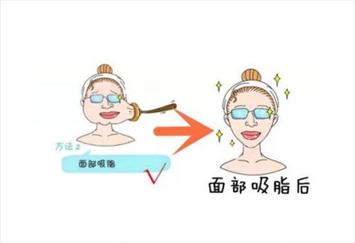 上海保障基地医院激光整形美容中心面部吸脂案例