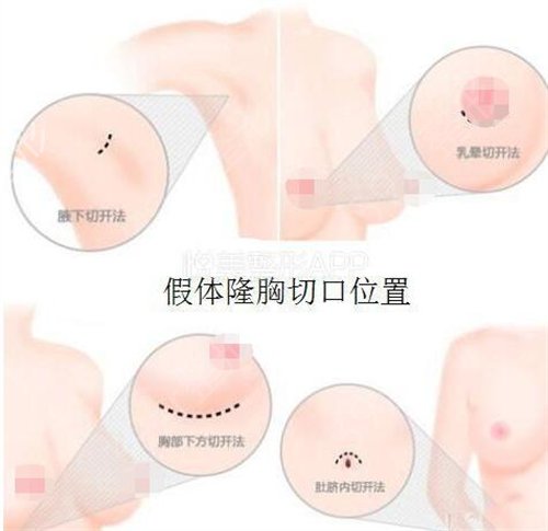 华北理工大学附属医院整形外科假体隆胸案例：
