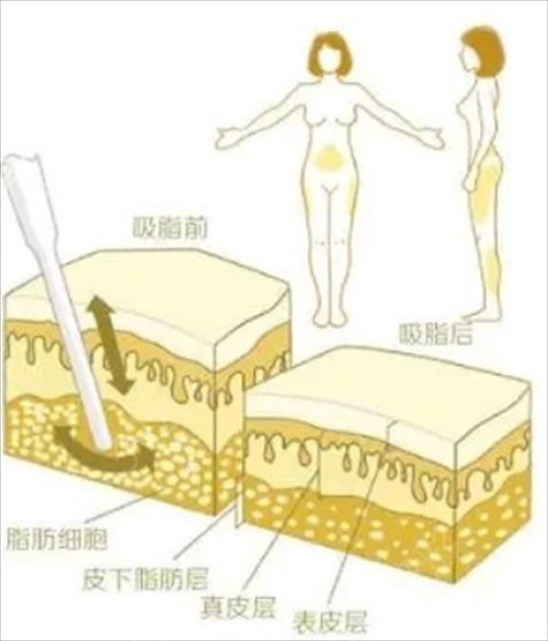 上海港华医院面部腰腹吸脂案例