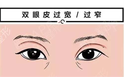 黑龙江省医院南岗分院双眼皮案例