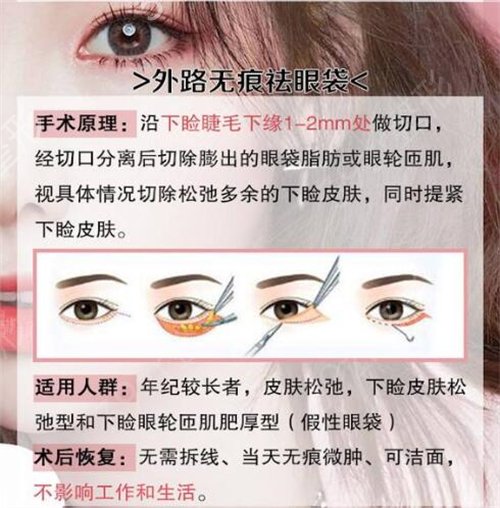 上海锦妍医疗美容门诊部祛眼袋案例