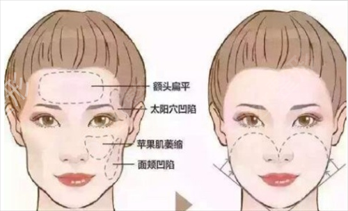 上海光博士医疗美容门诊部自体脂肪填充面部案例