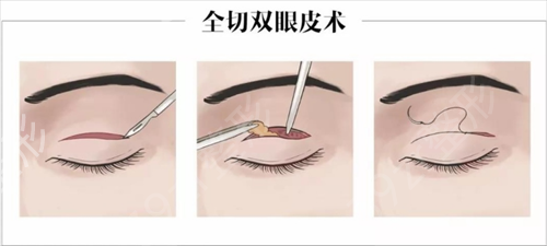 广西中医药大学附属瑞康医院整形外科全切双眼皮案例：