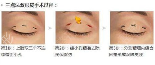 中国医大一院整形美容外科眼部案例