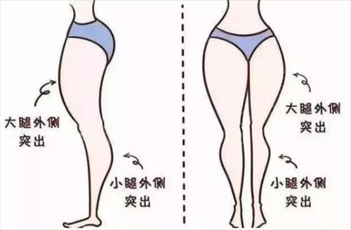 临沂市人民医院医学美容科吸脂瘦大腿案例： 